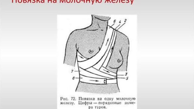 Техника наложения повязки на молочную железу